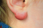 Borrelia lymphocytom. Symptom på borreliose. Mest vanlig hos barn.