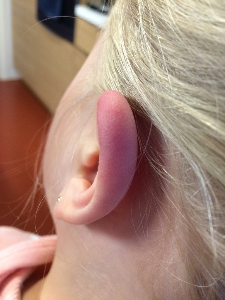 Borrelia lymfocytom på toppen av øret (helix). Jente 10 år. Samme person som på bildet over. Foto: Flåttsenteret