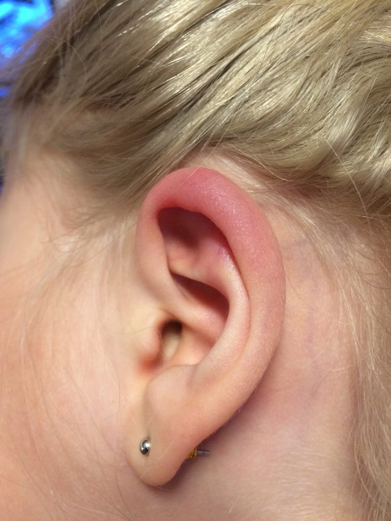 Borrelia lymfocytom på toppen av øret (helix). Jente 10 år. Hos barn er det vanligst å få borrelia lymfocytom på øret. Foto: Flåttsenteret