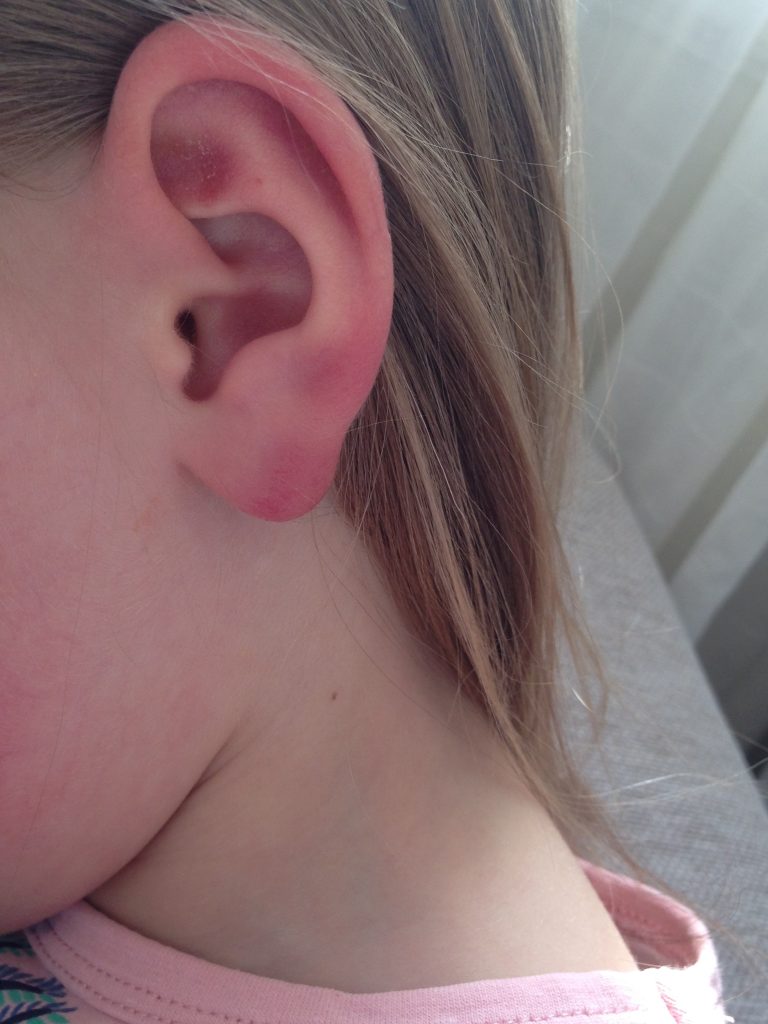Borrelia lymfocytom på øreflipp. Jente ca. 5 år. Foto: Flåttsenteret
